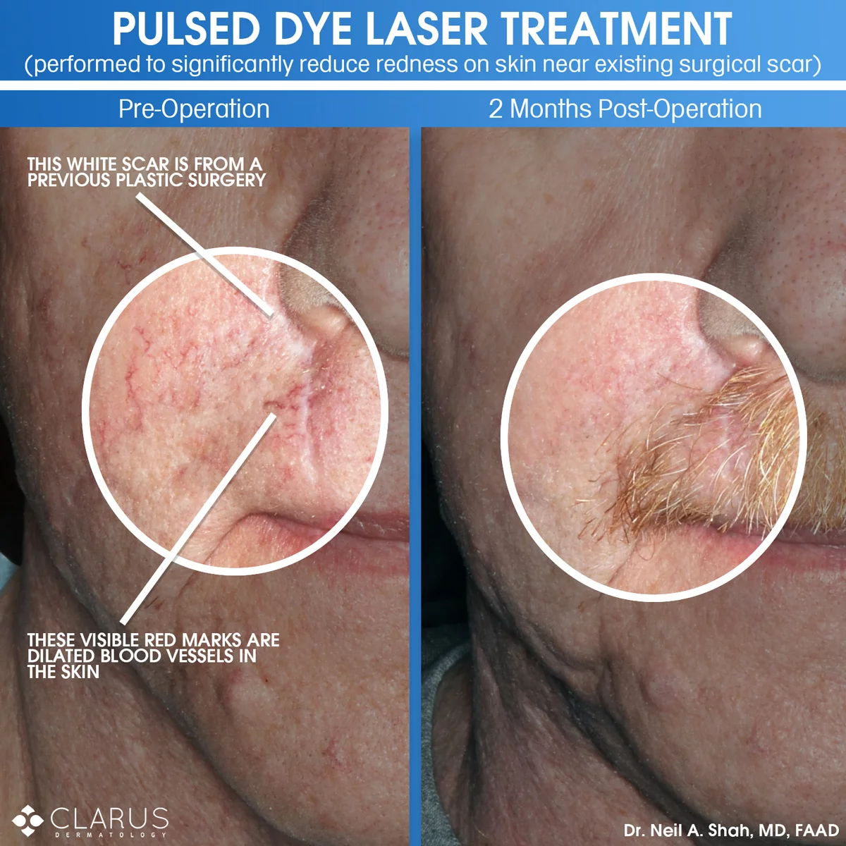 We use lasers in a number of treatments that we perform here at Clarus Dermatology. The improved aesthetic look of the skin from even one round of treatment can be quite stark. The before and after images here are from a patient that had a significant amount of redness on the skin of his cheek and upper lip, including a number of dilated blood vessels.