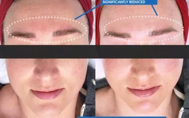 April, our Skin Technician, performs a lot of Hydrafacials at Clarus Dermatology, and that’s because it’s a treatment that is recommended for any of our patients to help improve the appearance of their facial skin, including those with even the most sensitive skin