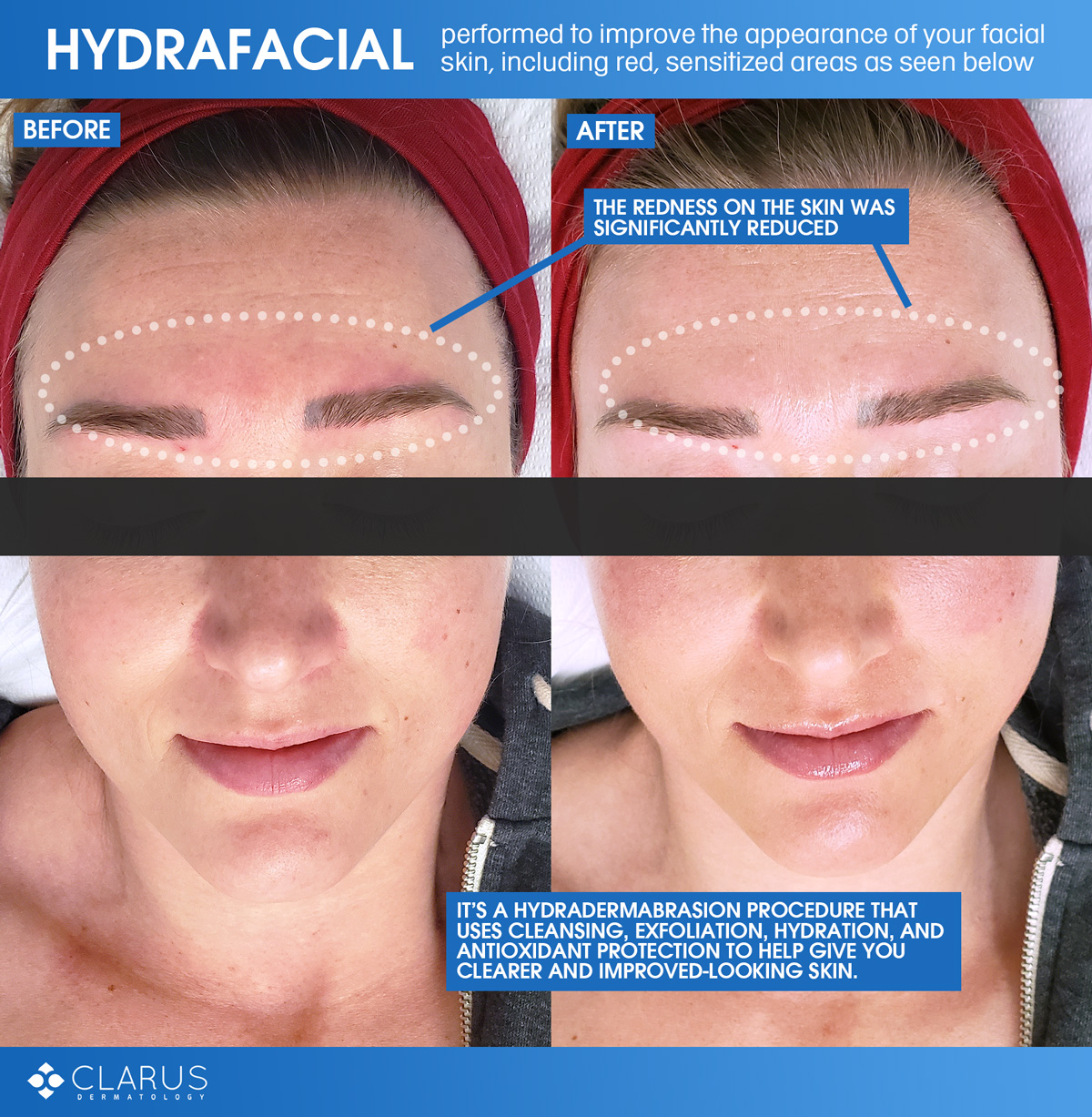 Hydrafacial Near Me