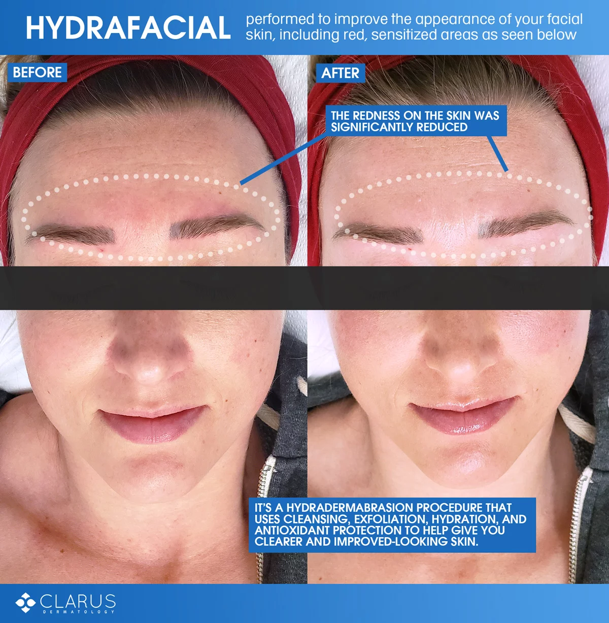 April, our Skin Technician, performs a lot of Hydrafacials at Clarus Dermatology, and that’s because it’s a treatment that is recommended for any of our patients to help improve the appearance of their facial skin, including those with even the most sensitive skin