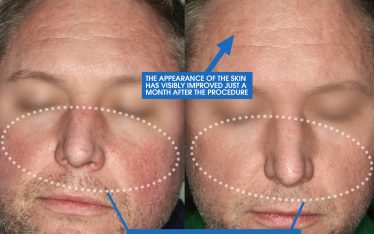 If IPL treatment sounds familiar, it might be because you’ve seen images that we’ve posted before to demonstrate how IPL reduced red and brown spots on our patient’s skin.