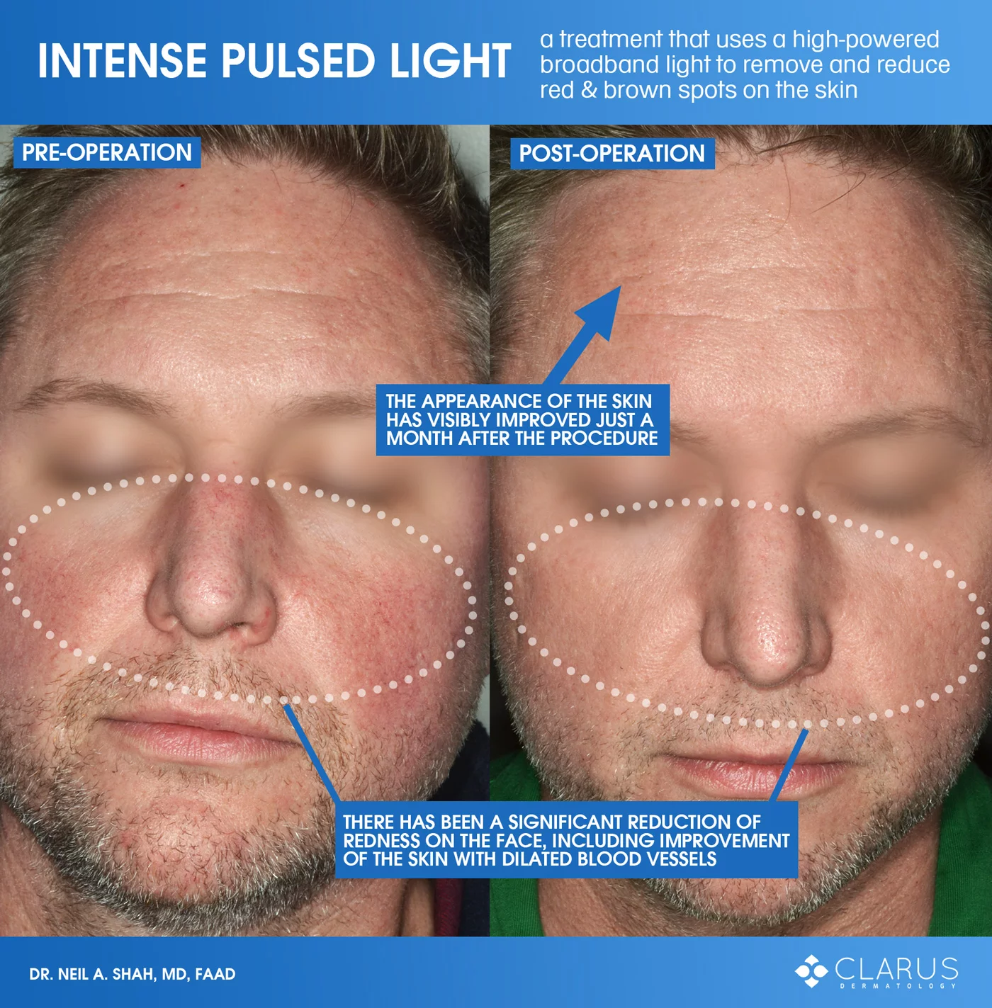 If IPL treatment sounds familiar, it might be because you’ve seen images that we’ve posted before to demonstrate how IPL reduced red and brown spots on our patient’s skin.