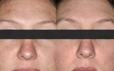 Rejuvapen is a microneedling treatment that we use at Clarus Dermatology for a variety of skin care issues - including ones related to sun damage and melasma (a common skin problem that causes brown and gray-brown patches on the face).