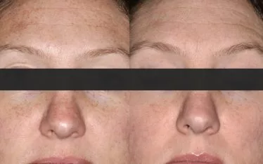 Rejuvapen is a microneedling treatment that we use at Clarus Dermatology for a variety of skin care issues - including ones related to sun damage and melasma (a common skin problem that causes brown and gray-brown patches on the face).