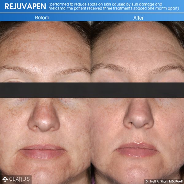Rejuvapen is a microneedling treatment that we use at Clarus Dermatology for a variety of skin care issues - including ones related to sun damage and melasma (a common skin problem that causes brown and gray-brown patches on the face).