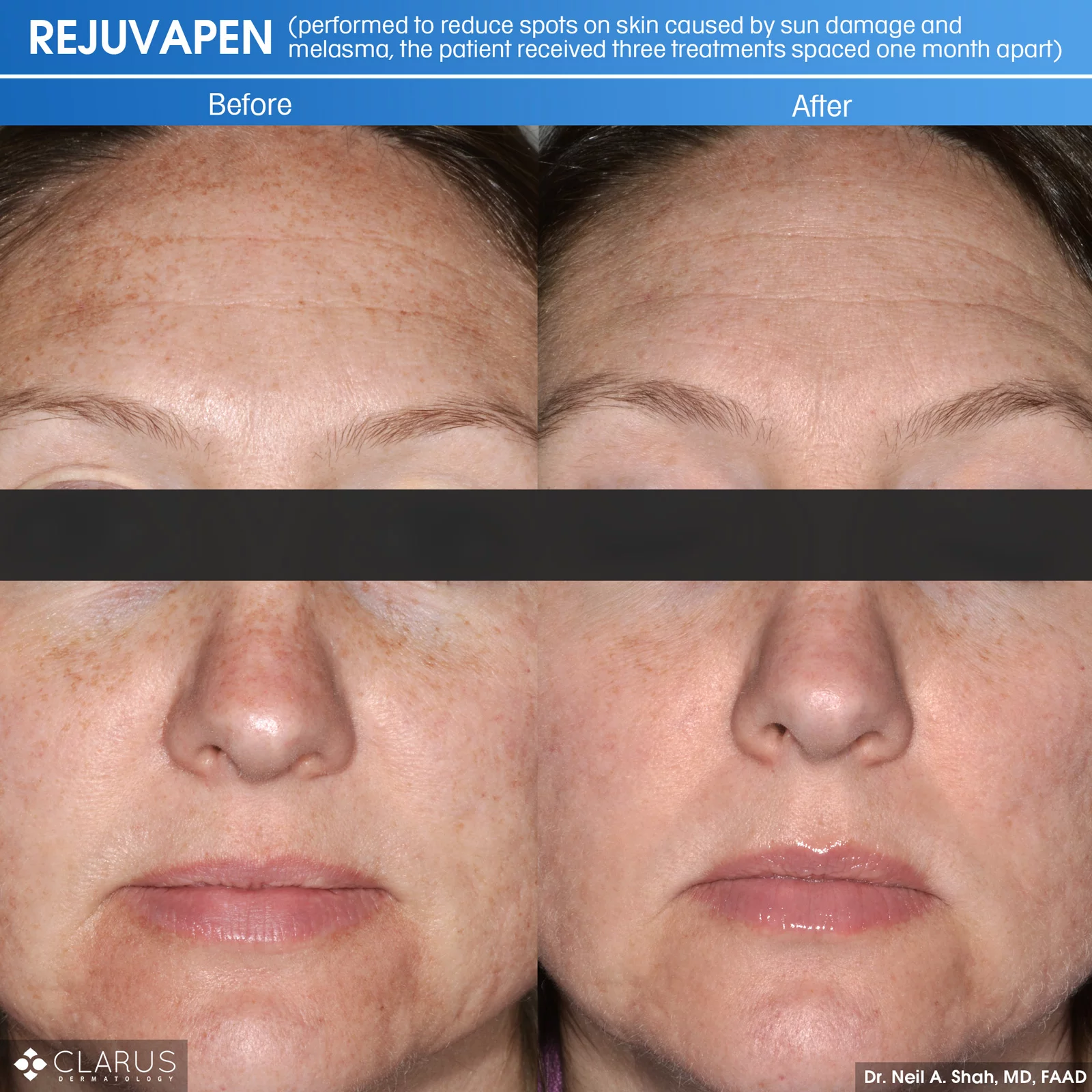 Rejuvapen is a microneedling treatment that we use at Clarus Dermatology for a variety of skin care issues - including ones related to sun damage and melasma (a common skin problem that causes brown and gray-brown patches on the face).