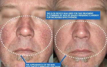 When it comes to the treatments that we perform at Clarus Dermatology, IPL (Intense Pulsed Light) consistently delivers results for our patients. When we look at the before and after images, the visible improvements after just a single treatment are quite apparent.