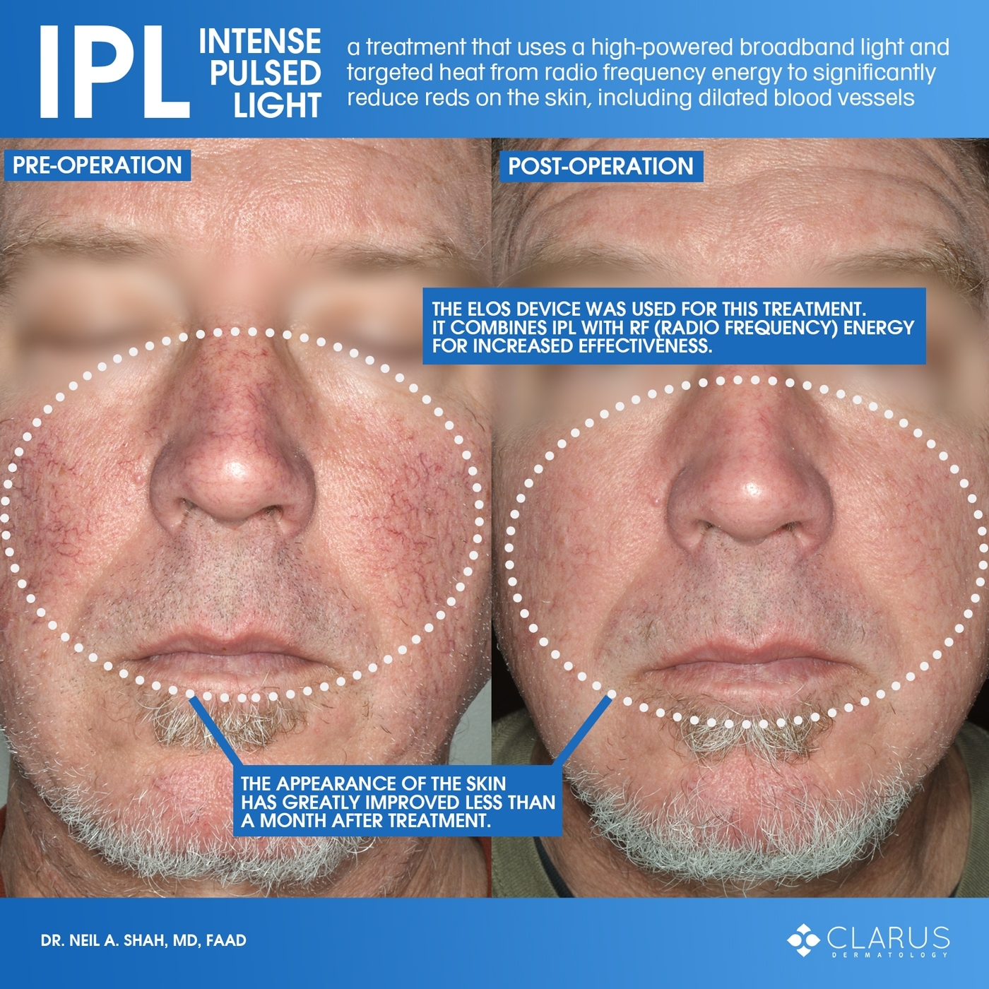 When it comes to the treatments that we perform at Clarus Dermatology, IPL (Intense Pulsed Light) consistently delivers results for our patients. When we look at the before and after images, the visible improvements after just a single treatment are quite apparent.