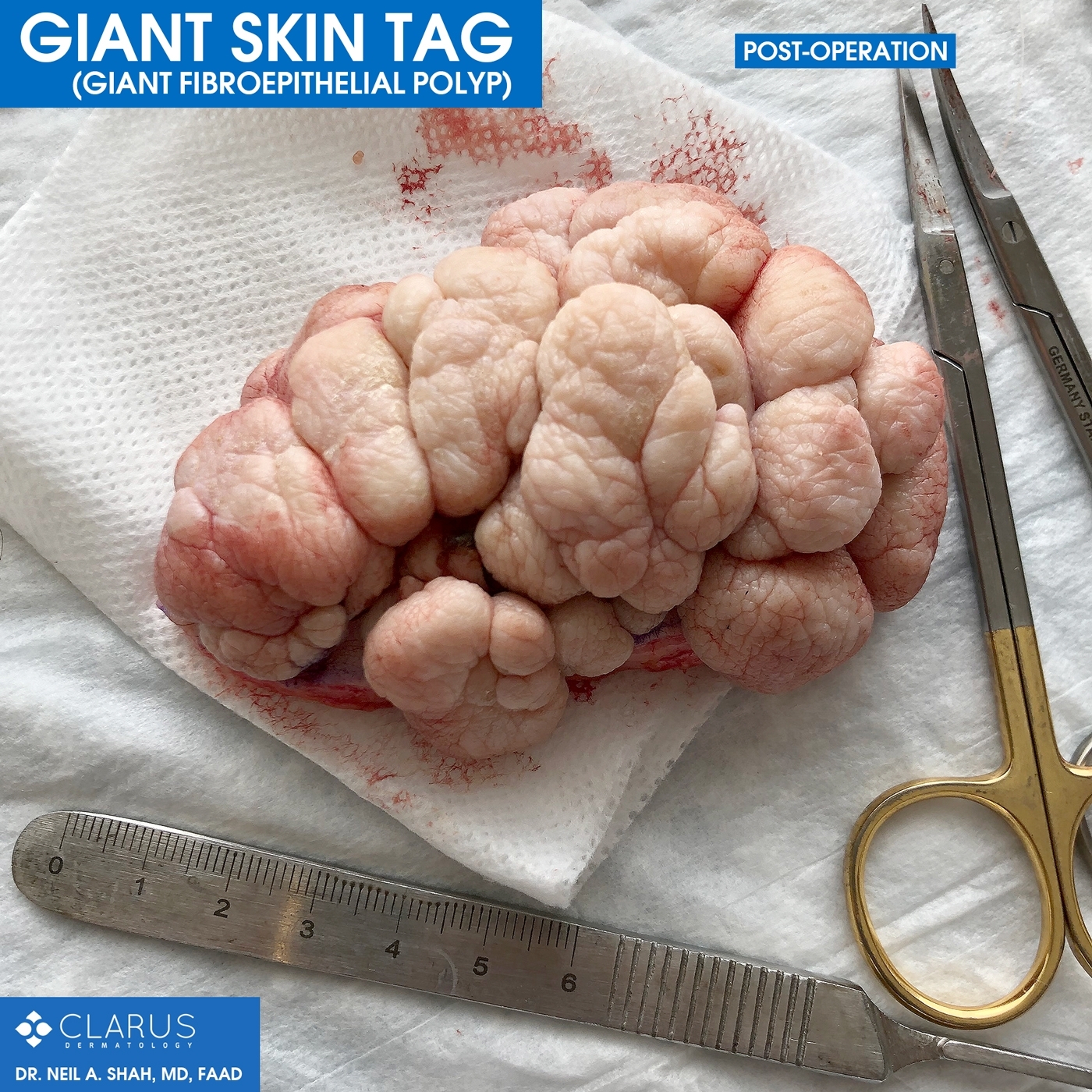 The images are from a patient that board-certified dermatologist Dr. Neil Shah recently saw here at Clarus Dermatology. The large, harmless tumor was determined to most likely be a giant skin tag, known formally as a giant fibroepithelial polyp.