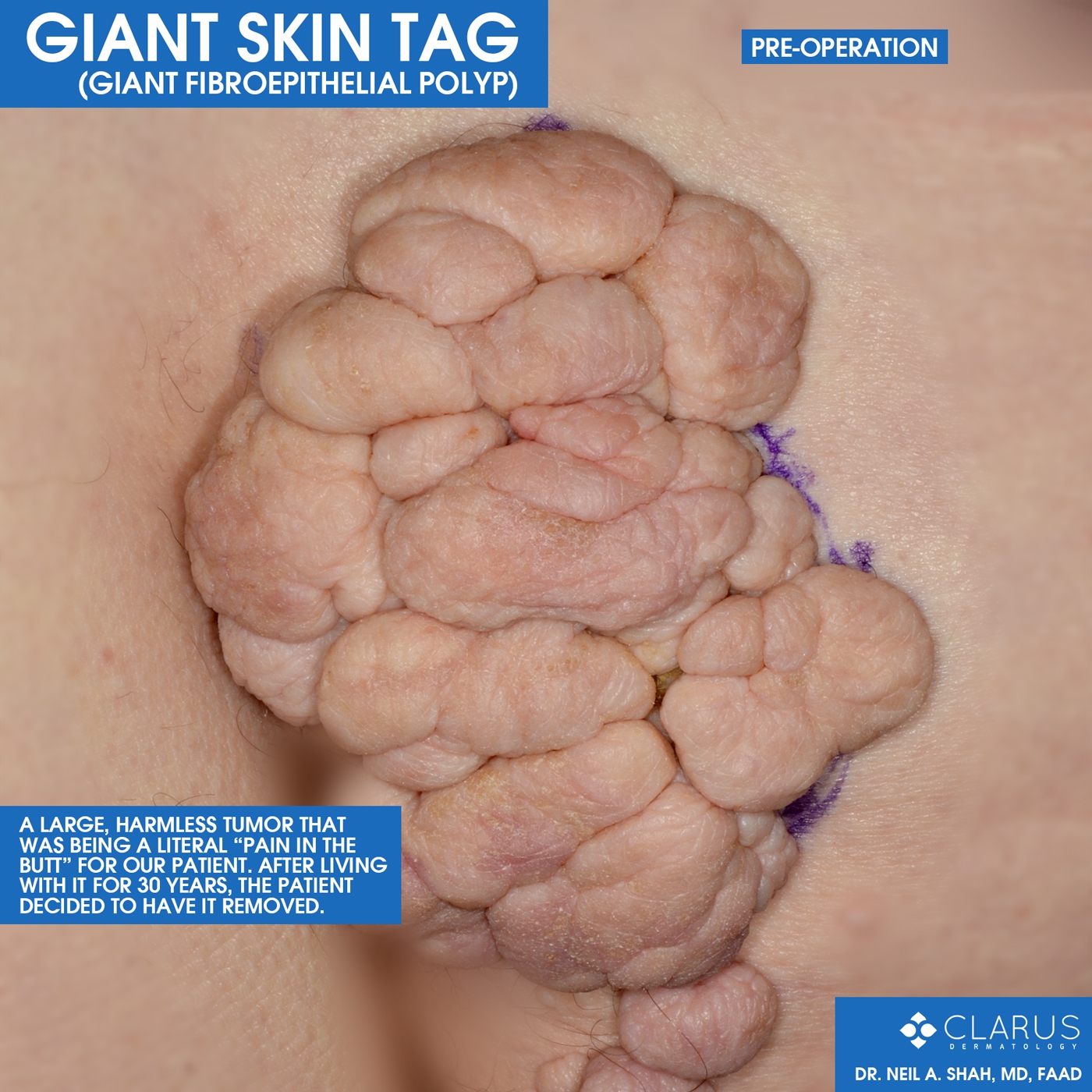 The images are from a patient that board-certified dermatologist Dr. Neil Shah recently saw here at Clarus Dermatology. The large, harmless tumor was determined to most likely be a giant skin tag, known formally as a giant fibroepithelial polyp.