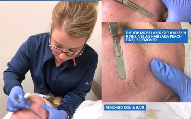 Clarus Dermatology is offering a new way to exfoliate your facial skin. Our Skin Technician April is now performing a treatment called dermaplaning, which involves gently “shaving” the top-most layer of dead skin and fine, vellus hair (aka peach fuzz) off of the face.