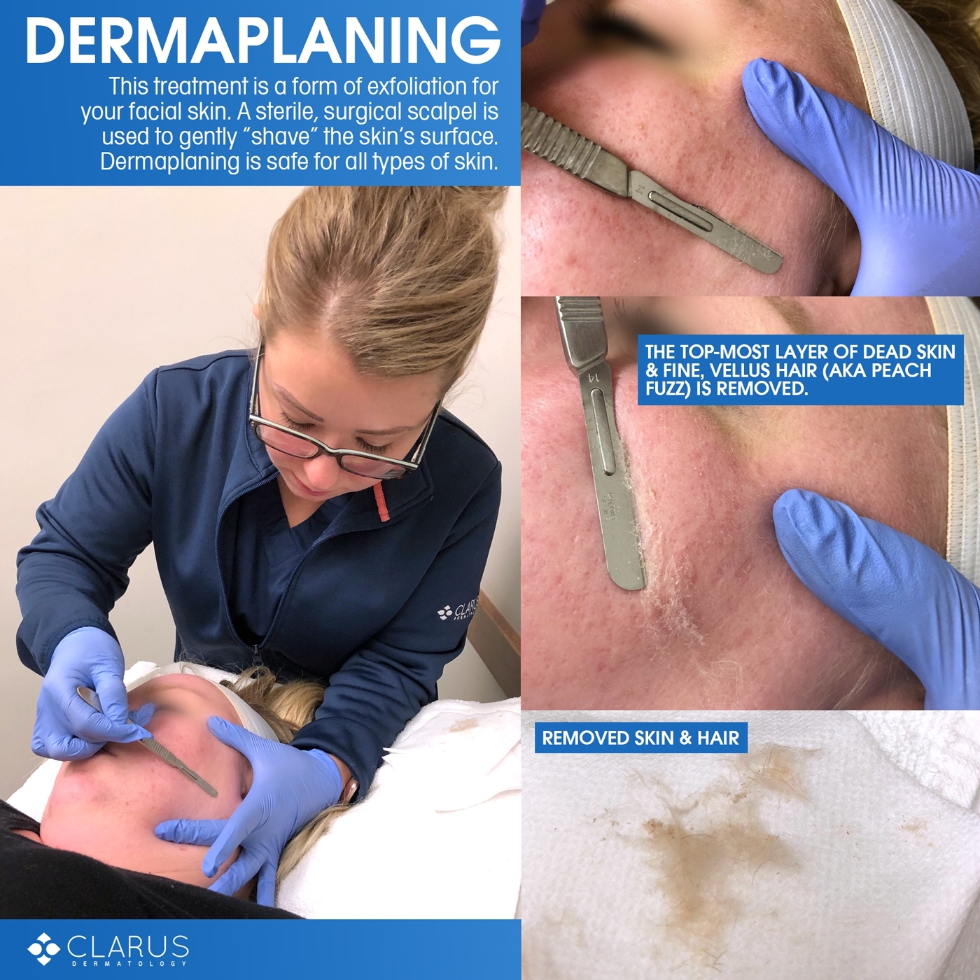 Clarus Dermatology is offering a new way to exfoliate your facial skin. Our Skin Technician April is now performing a treatment called dermaplaning, which involves gently “shaving” the top-most layer of dead skin and fine, vellus hair (aka peach fuzz) off of the face.