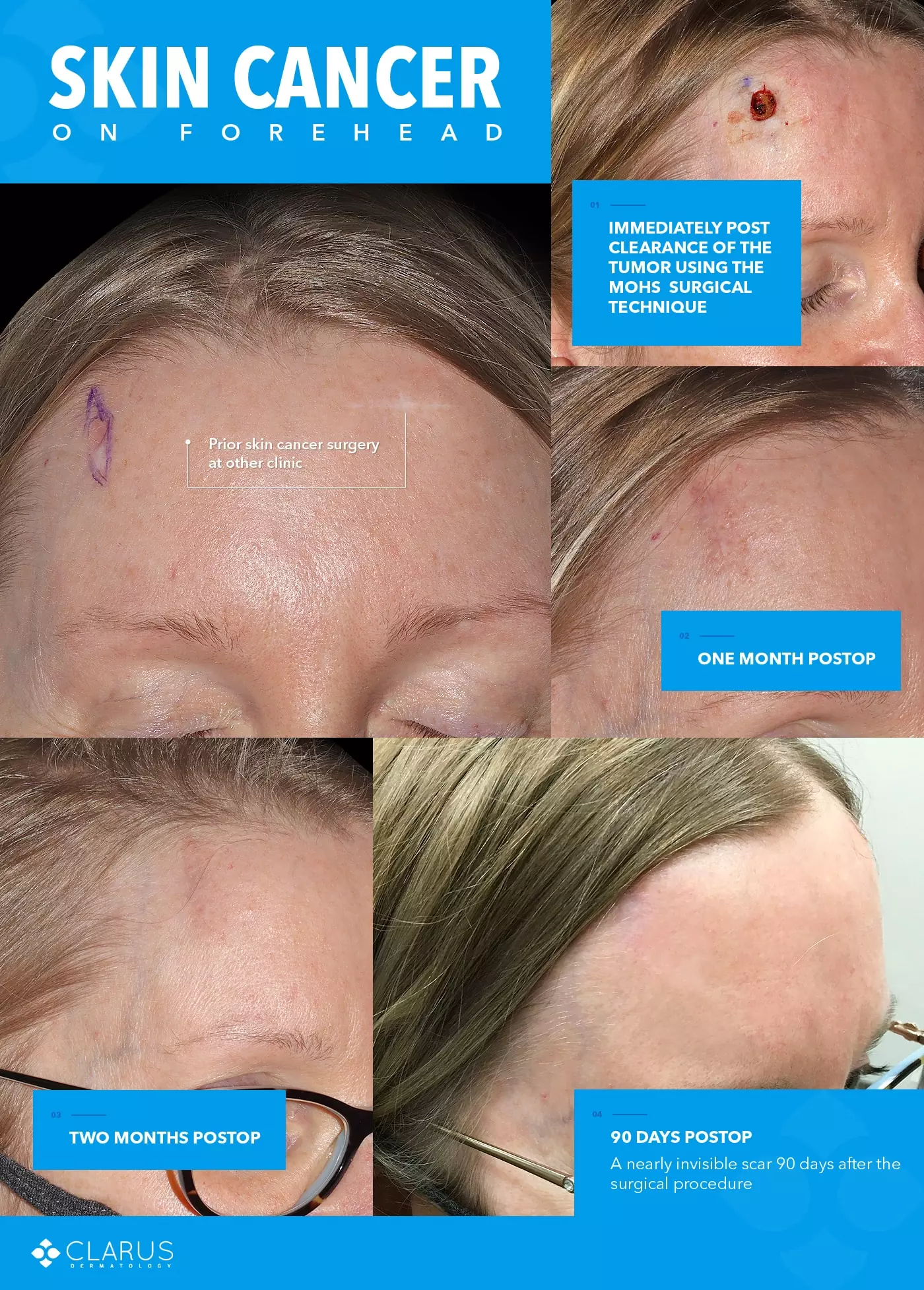 Skin Cancer Forhead