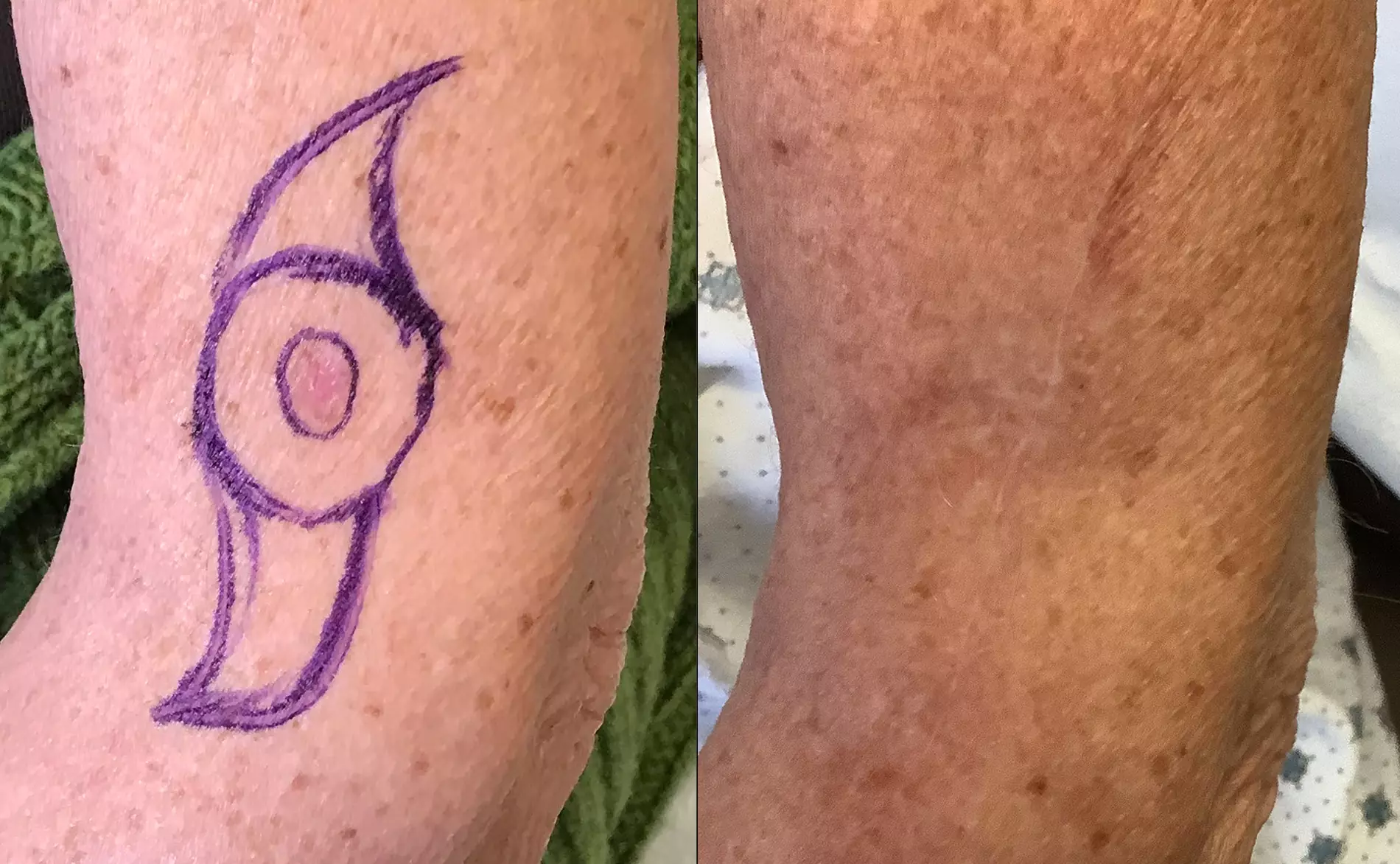 Re-Excision Left Distal Arm
