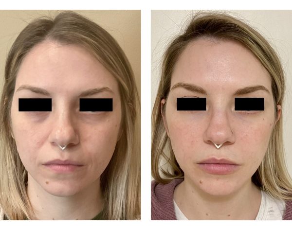 Botox filler