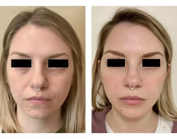 Botox filler