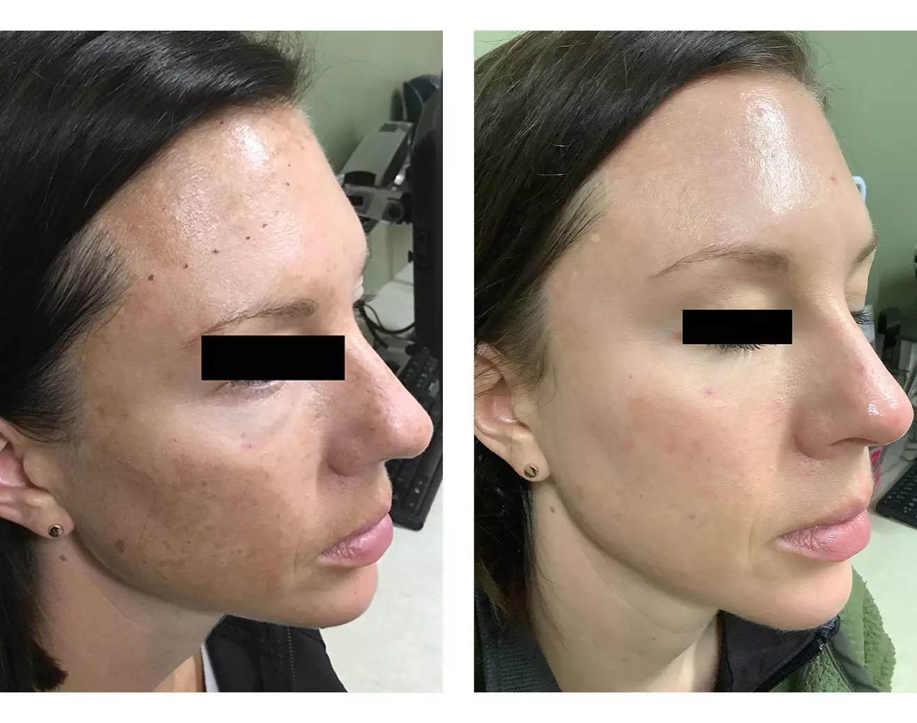 Medium depth chemical peel