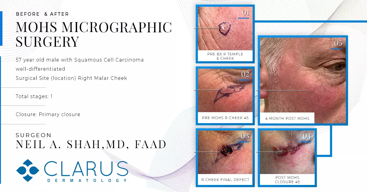 Mohs micrographic surgery