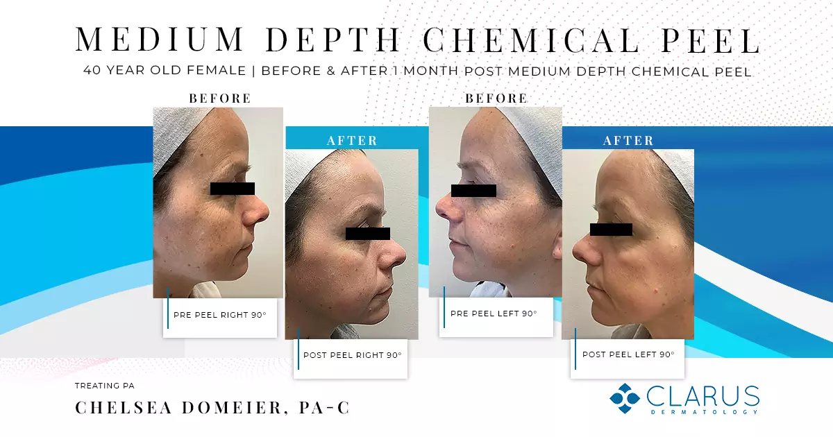 Medium depth chemical peel