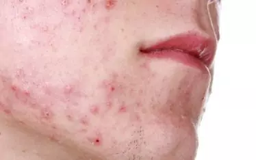 acne