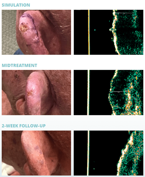 Image-Guided Superficial Radiation Therapy (IG-SRT)