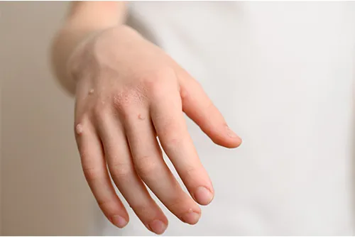 wart-removal wart removal