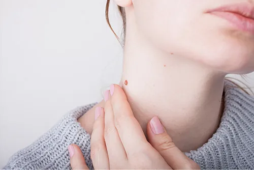 wart-removal-3 wart removal