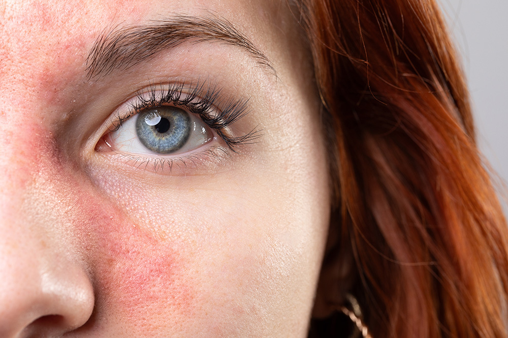 A Guide to Rosacea: Causes, Symptoms, and Treatments - Clarus ...